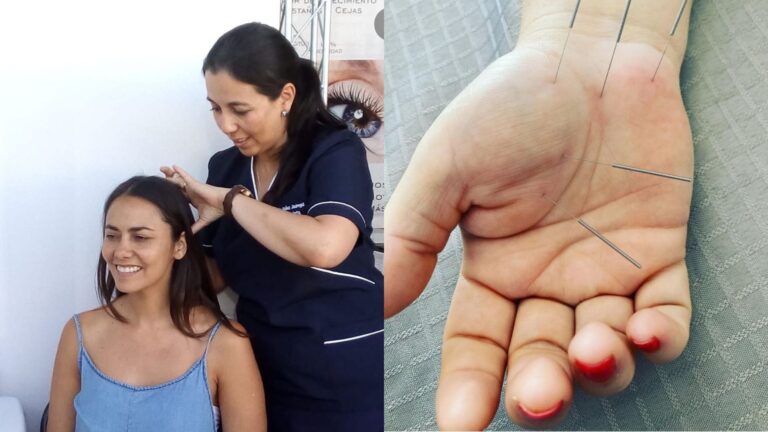 Cruz Roja de Puente Alto retoma atenciones de acupuntura a bajo costo
